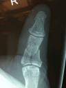 thumb x-ray before